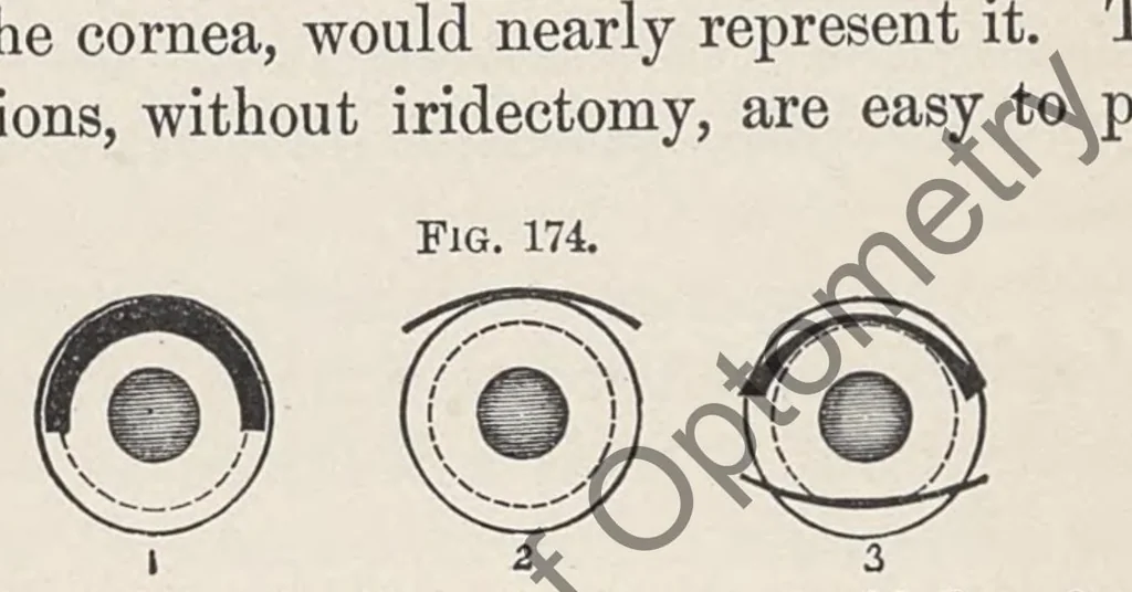 An illustration from Diseases of the eye, 1900, leaf 447
