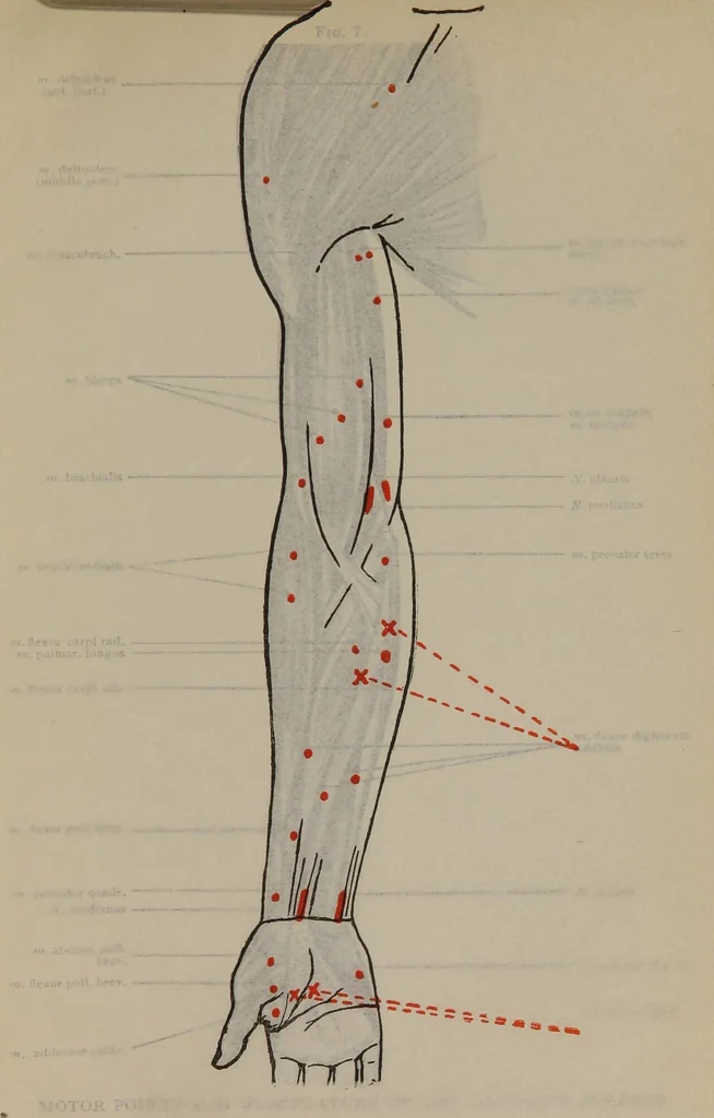An illustration from Nursing and care of the nervous and the insane, 1915, leaf 98