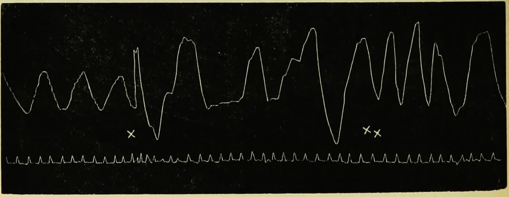 An illustration from Psycho-therapeutics : or, treatment by hypnotism and suggestion, 1891, leaf 241