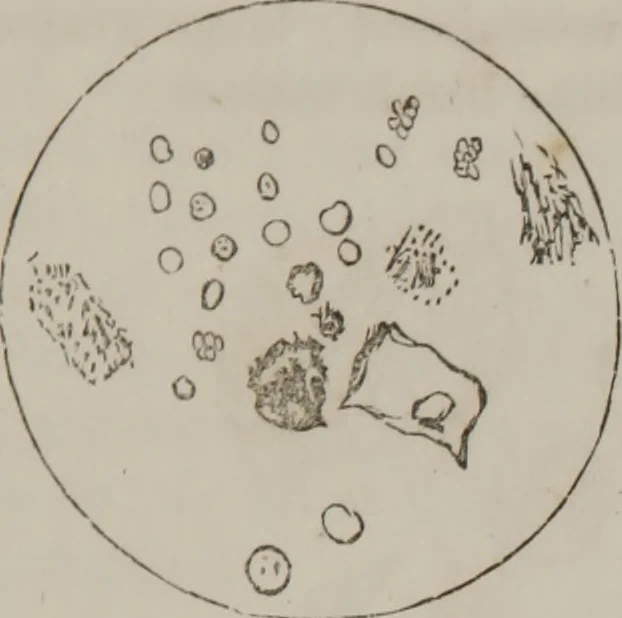 An illustration from Illustrations of disease with the microscope. clinical investigations, aided by the microscope, and by chemical reagents, with microscopical observations of pathological specimens, medical and surgical, obtained in Charleston, S.C. : a contribution intended to disclose the minute history of the diseases prevailing in this latitude, and to assist future students, 1861, leaf 102