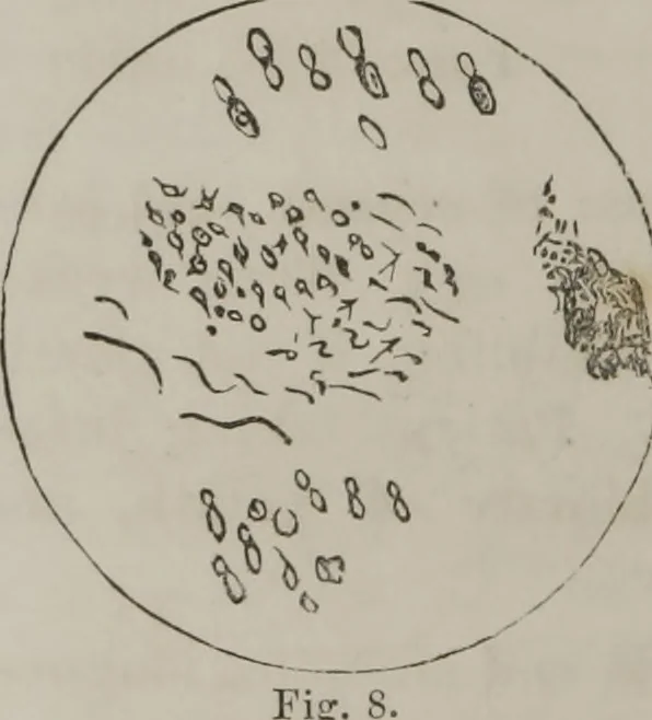 An illustration from Illustrations of disease with the microscope. clinical investigations, aided by the microscope, and by chemical reagents, with microscopical observations of pathological specimens, medical and surgical, obtained in Charleston, S.C. : a contribution intended to disclose the minute history of the diseases prevailing in this latitude, and to assist future students, 1861, leaf 103