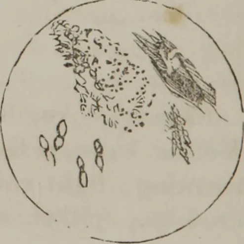 An illustration from Illustrations of disease with the microscope. clinical investigations, aided by the microscope, and by chemical reagents, with microscopical observations of pathological specimens, medical and surgical, obtained in Charleston, S.C. : a contribution intended to disclose the minute history of the diseases prevailing in this latitude, and to assist future students, 1861, leaf 103