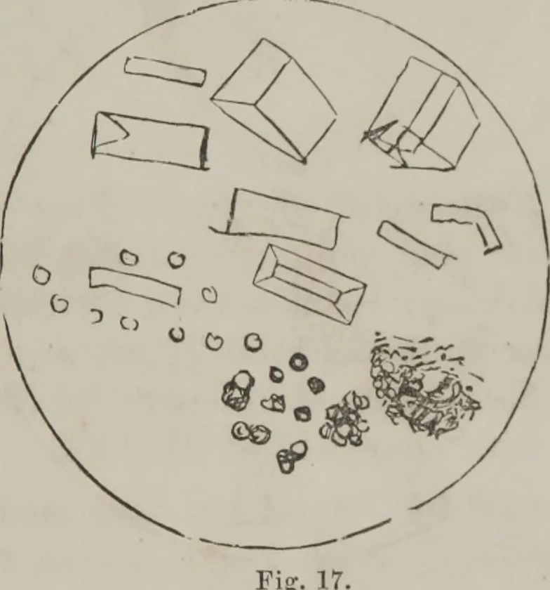 An illustration from Illustrations of disease with the microscope. clinical investigations, aided by the microscope, and by chemical reagents, with microscopical observations of pathological specimens, medical and surgical, obtained in Charleston, S.C. : a contribution intended to disclose the minute history of the diseases prevailing in this latitude, and to assist future students, 1861, leaf 106