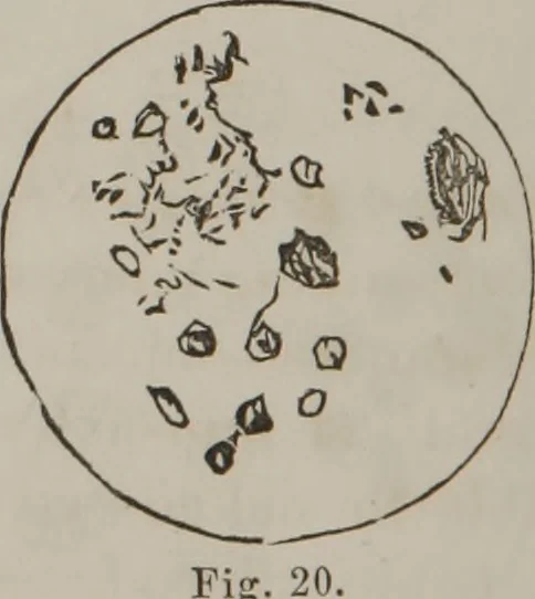 An illustration from Illustrations of disease with the microscope. clinical investigations, aided by the microscope, and by chemical reagents, with microscopical observations of pathological specimens, medical and surgical, obtained in Charleston, S.C. : a contribution intended to disclose the minute history of the diseases prevailing in this latitude, and to assist future students, 1861, leaf 107