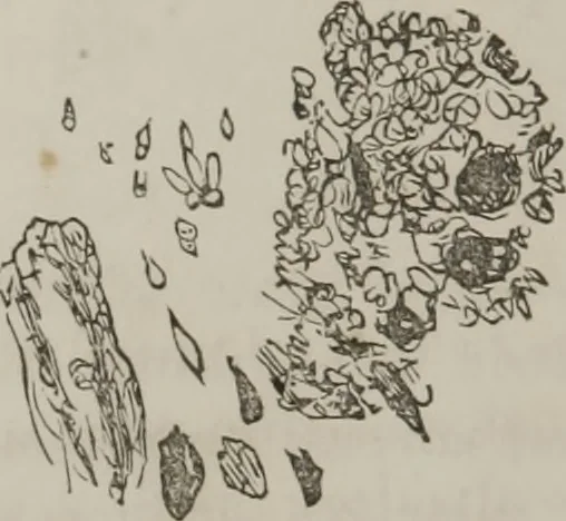 An illustration from Illustrations of disease with the microscope. clinical investigations, aided by the microscope, and by chemical reagents, with microscopical observations of pathological specimens, medical and surgical, obtained in Charleston, S.C. : a contribution intended to disclose the minute history of the diseases prevailing in this latitude, and to assist future students, 1861, leaf 111
