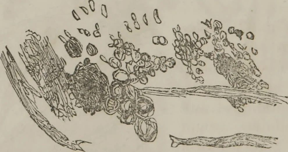 An illustration from Illustrations of disease with the microscope. clinical investigations, aided by the microscope, and by chemical reagents, with microscopical observations of pathological specimens, medical and surgical, obtained in Charleston, S.C. : a contribution intended to disclose the minute history of the diseases prevailing in this latitude, and to assist future students, 1861, leaf 111
