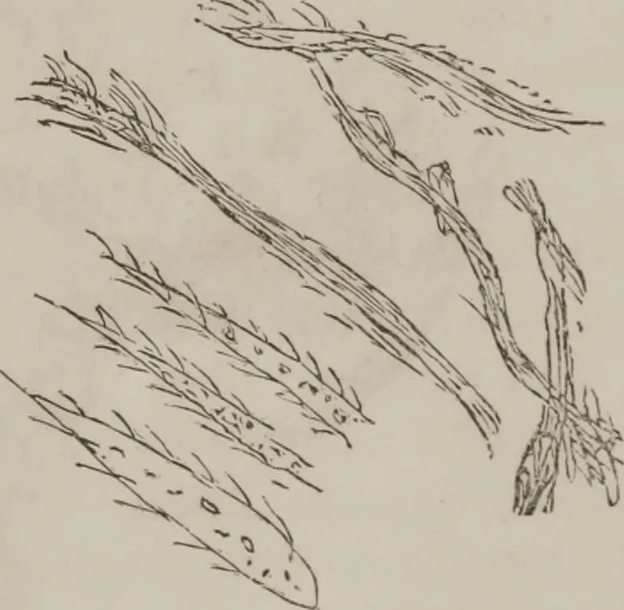 An illustration from Illustrations of disease with the microscope. clinical investigations, aided by the microscope, and by chemical reagents, with microscopical observations of pathological specimens, medical and surgical, obtained in Charleston, S.C. : a contribution intended to disclose the minute history of the diseases prevailing in this latitude, and to assist future students, 1861, leaf 112