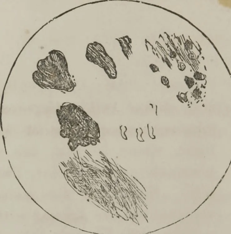 An illustration from Illustrations of disease with the microscope. clinical investigations, aided by the microscope, and by chemical reagents, with microscopical observations of pathological specimens, medical and surgical, obtained in Charleston, S.C. : a contribution intended to disclose the minute history of the diseases prevailing in this latitude, and to assist future students, 1861, leaf 113