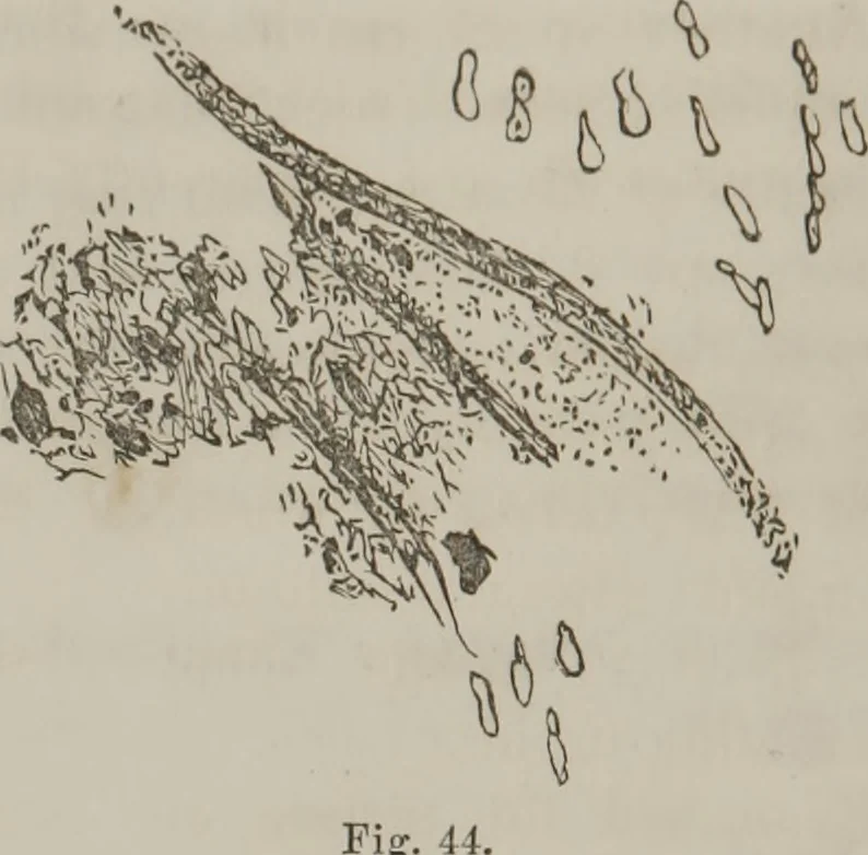 An illustration from Illustrations of disease with the microscope. clinical investigations, aided by the microscope, and by chemical reagents, with microscopical observations of pathological specimens, medical and surgical, obtained in Charleston, S.C. : a contribution intended to disclose the minute history of the diseases prevailing in this latitude, and to assist future students, 1861, leaf 117
