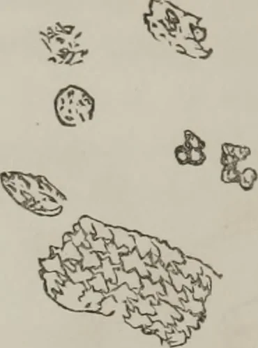 An illustration from Illustrations of disease with the microscope. clinical investigations, aided by the microscope, and by chemical reagents, with microscopical observations of pathological specimens, medical and surgical, obtained in Charleston, S.C. : a contribution intended to disclose the minute history of the diseases prevailing in this latitude, and to assist future students, 1861, leaf 119
