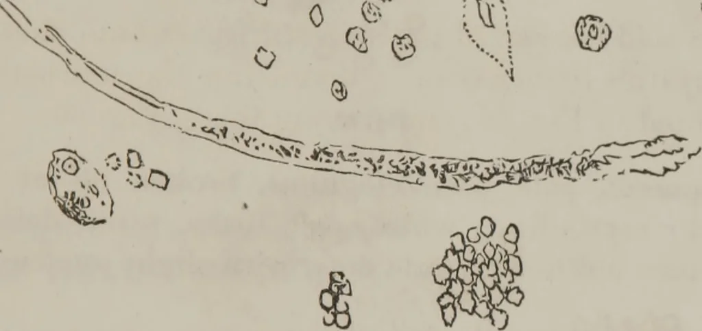 An illustration from Illustrations of disease with the microscope. clinical investigations, aided by the microscope, and by chemical reagents, with microscopical observations of pathological specimens, medical and surgical, obtained in Charleston, S.C. : a contribution intended to disclose the minute history of the diseases prevailing in this latitude, and to assist future students, 1861, leaf 124