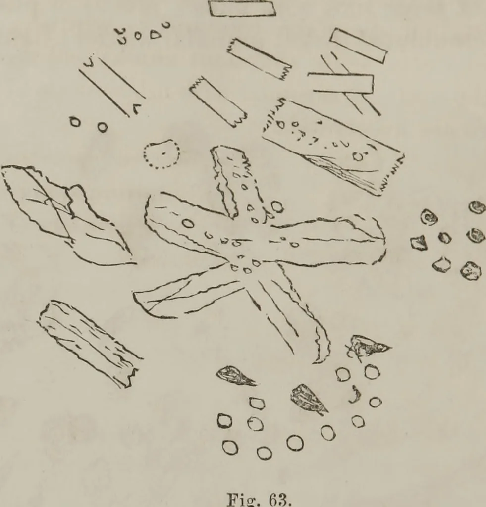 An illustration from Illustrations of disease with the microscope. clinical investigations, aided by the microscope, and by chemical reagents, with microscopical observations of pathological specimens, medical and surgical, obtained in Charleston, S.C. : a contribution intended to disclose the minute history of the diseases prevailing in this latitude, and to assist future students, 1861, leaf 125