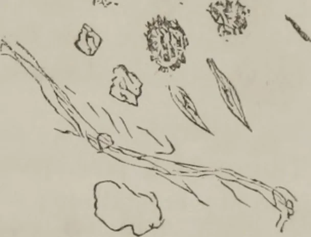 An illustration from Illustrations of disease with the microscope. clinical investigations, aided by the microscope, and by chemical reagents, with microscopical observations of pathological specimens, medical and surgical, obtained in Charleston, S.C. : a contribution intended to disclose the minute history of the diseases prevailing in this latitude, and to assist future students, 1861, leaf 126