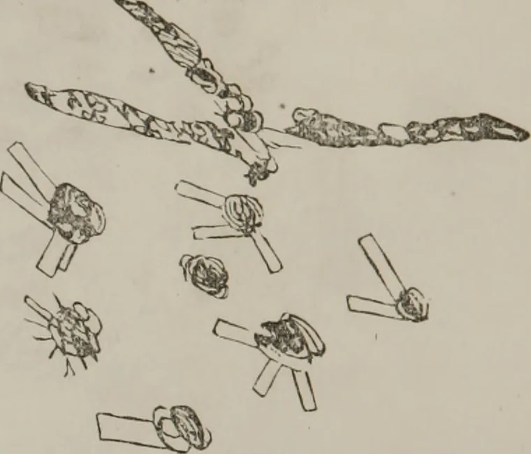An illustration from Illustrations of disease with the microscope. clinical investigations, aided by the microscope, and by chemical reagents, with microscopical observations of pathological specimens, medical and surgical, obtained in Charleston, S.C. : a contribution intended to disclose the minute history of the diseases prevailing in this latitude, and to assist future students, 1861, leaf 131