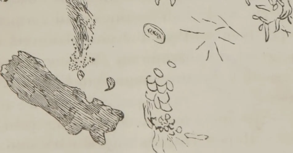 An illustration from Illustrations of disease with the microscope. clinical investigations, aided by the microscope, and by chemical reagents, with microscopical observations of pathological specimens, medical and surgical, obtained in Charleston, S.C. : a contribution intended to disclose the minute history of the diseases prevailing in this latitude, and to assist future students, 1861, leaf 134