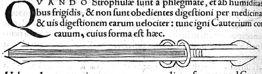 An illustration from Octavii Horatiani Rerum medicarum libri quatuor. I Logicus, de curationibus omnium ferme morborum corporis humani... II. De acutis et chronicis passionibus... III. Gynecia, de mulierum accidentibus et curis eorumdem... IV. De physica scientia, experimentorum liber. Per Heremanum comitem a Neuenar, integro candori nuper restitutus autor. Albucasis,... Libri tres I. De cauterio cum igne et medicinis acutis per singula corporis humani membro... II. De sectione et perforatione phlebotomia, et ventosis ; de vulneribus et extractione sagittarum... III. De restauratione et curatione dislocationis membrorum..., 1532, leaf 139