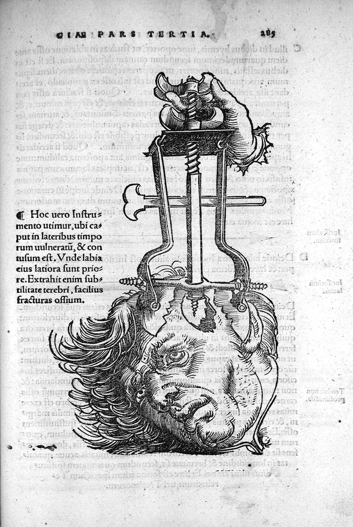 An illustration from Octavii Horatiani Rerum medicarum libri quatuor. I Logicus, de curationibus omnium ferme morborum corporis humani... II. De acutis et chronicis passionibus... III. Gynecia, de mulierum accidentibus et curis eorumdem... IV. De physica scientia, experimentorum liber. Per Heremanum comitem a Neuenar, integro candori nuper restitutus autor. Albucasis,... Libri tres I. De cauterio cum igne et medicinis acutis per singula corporis humani membro... II. De sectione et perforatione phlebotomia, et ventosis ; de vulneribus et extractione sagittarum... III. De restauratione et curatione dislocationis membrorum..., 1532, leaf 292