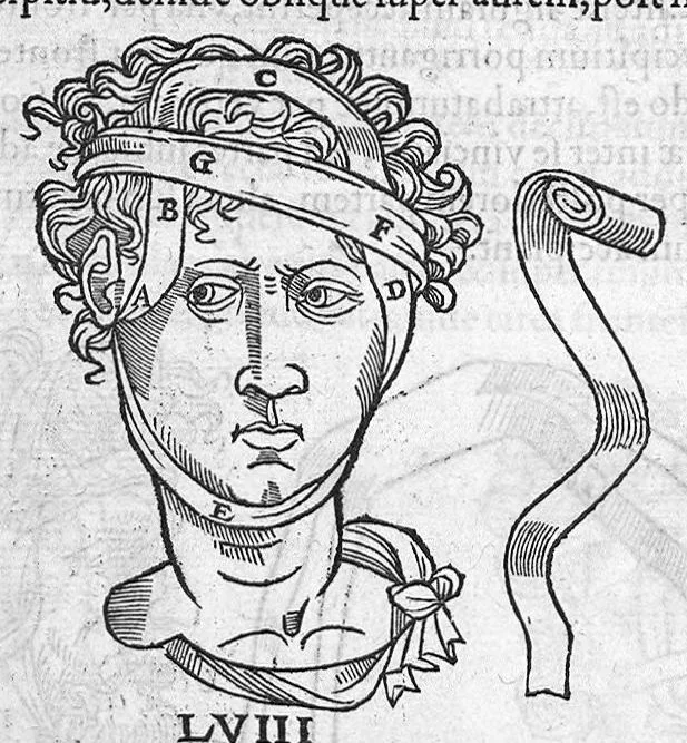 An illustration from Chirurgia è graeco in latinum conversa, Vido Vidio Florentino interprete, cum nonnullis ejusdem Vidii co[m]mentariis, 1544, leaf 475