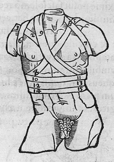 An illustration from Chirurgia è graeco in latinum conversa, Vido Vidio Florentino interprete, cum nonnullis ejusdem Vidii co[m]mentariis, 1544, leaf 482