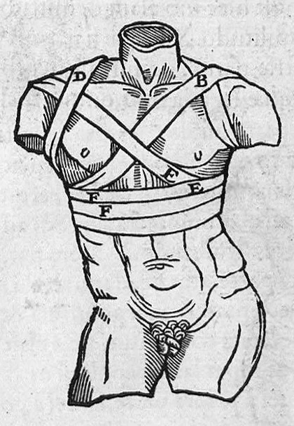 An illustration from Chirurgia è graeco in latinum conversa, Vido Vidio Florentino interprete, cum nonnullis ejusdem Vidii co[m]mentariis, 1544, leaf 482