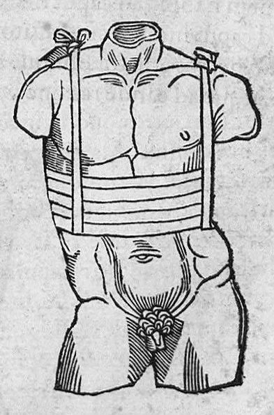 An illustration from Chirurgia è graeco in latinum conversa, Vido Vidio Florentino interprete, cum nonnullis ejusdem Vidii co[m]mentariis, 1544, leaf 482