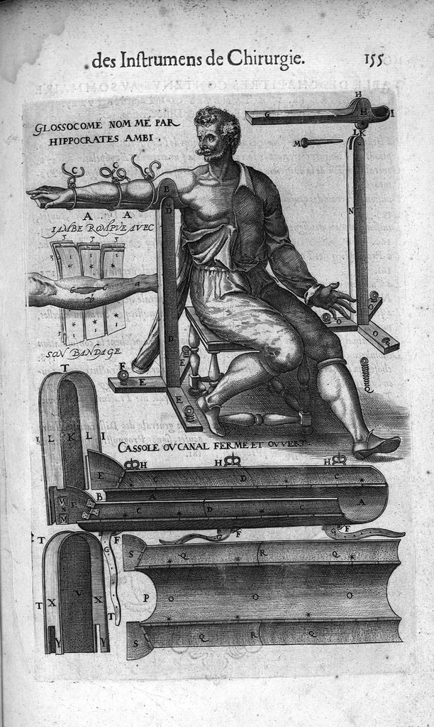 An illustration from Les Oeuvres de chirurgie de Jacques Guillemeau, chirurgien ordinaire du Roy et Juré à paris, divisées en treize livres. Avec les Portraicts & Figures Anatomiques de toutes les parties du corps humain. Et des Instrumens necessaires au Chirurgien. Derniere edition, 1602, leaf 180