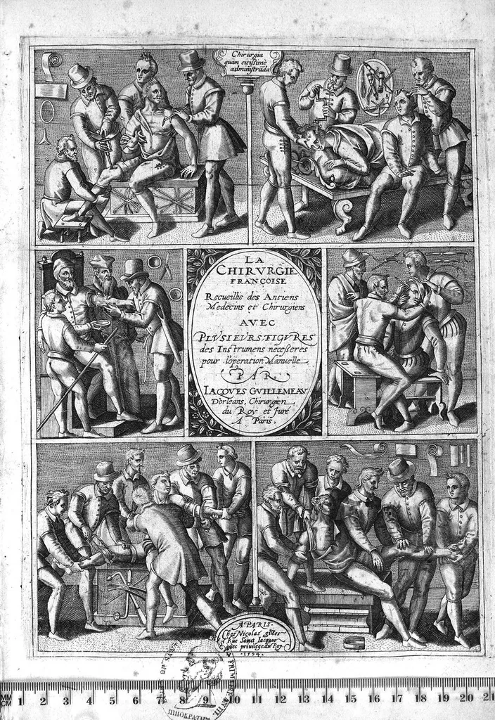 An illustration from La chirurgie françoise, recueillie des Anciens Medecins et Chirurgiens avec plusieurs figures des Instrumens necesseres pour l’operation Manuelle par Jacques Guillemeau D’Orleans, Chirurgien du Roy et Juré a Paris, 1594, leaf 0