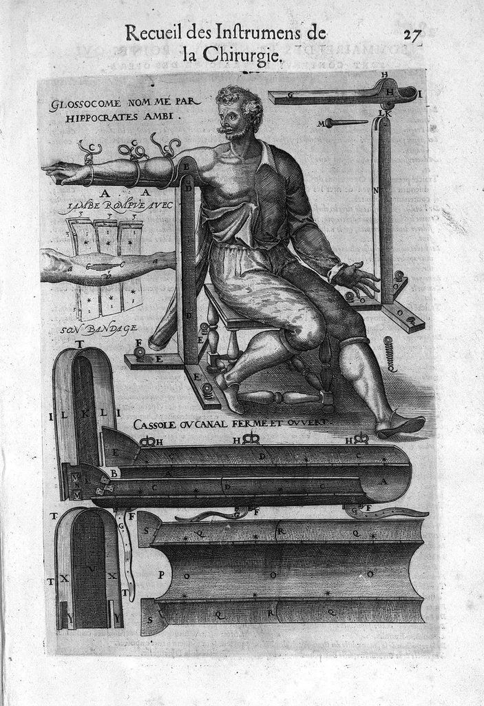 An illustration from La chirurgie françoise, recueillie des Anciens Medecins et Chirurgiens avec plusieurs figures des Instrumens necesseres pour l’operation Manuelle par Jacques Guillemeau D’Orleans, Chirurgien du Roy et Juré a Paris, 1594, leaf 34