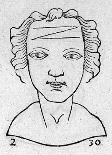 An illustration from Metoposcopia liber tredecim, et octingentis faciei humanae eiconibus complexa : cui accessit melampodis de naevis corporis tractatus, graece et latine nunc primum editus, 1658, leaf 166
