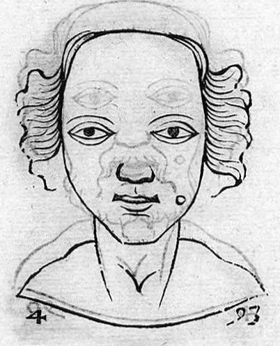 An illustration from Metoposcopia liber tredecim, et octingentis faciei humanae eiconibus complexa : cui accessit melampodis de naevis corporis tractatus, graece et latine nunc primum editus, 1658, leaf 221