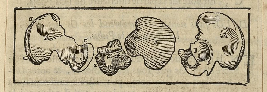 An illustration from L'Oeconomie chirurgicale, pour le r'habillement des os du corps humain contenant l'ostéologie, la nososreologie, l'apocatastosteologie, & le Traitté des bandages, 1671, leaf 155