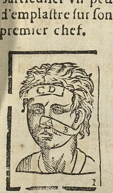 An illustration from L'Oeconomie chirurgicale, pour le r'habillement des os du corps humain contenant l'ostéologie, la nososreologie, l'apocatastosteologie, & le Traitté des bandages, 1671, leaf 431