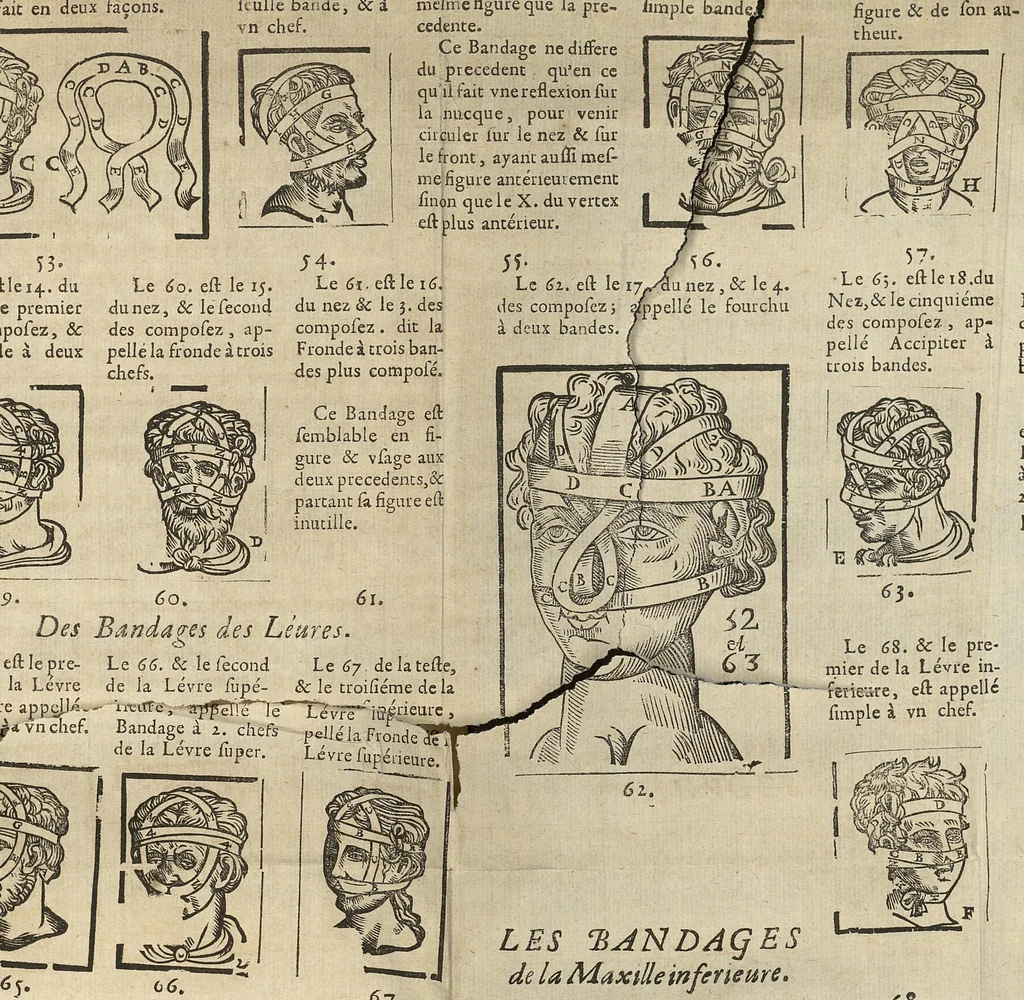 An illustration from L'Oeconomie chirurgicale, pour le r'habillement des os du corps humain contenant l'ostéologie, la nososreologie, l'apocatastosteologie, & le Traitté des bandages, 1671, leaf 447