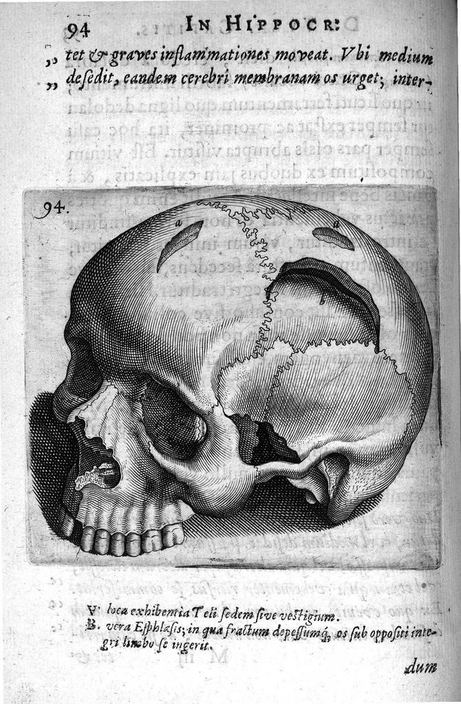 An illustration from Petri Paaw Amsteldamensis Succenturiatus Anatomicus. continens Commentaria in Hippocratem, de Capitis Vulneribus. additae In aliquot Capita libri VIII C. Celsi Explicationes. Ad illustres, Nobiles, Praepotentes, ac verè Magnifices Hollandiae Westfrisiaeque Ordines., 1616, leaf 103
