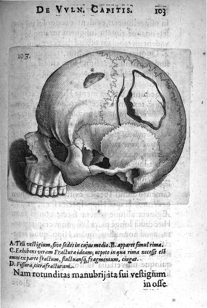 An illustration from Petri Paaw Amsteldamensis Succenturiatus Anatomicus. continens Commentaria in Hippocratem, de Capitis Vulneribus. additae In aliquot Capita libri VIII C. Celsi Explicationes. Ad illustres, Nobiles, Praepotentes, ac verè Magnifices Hollandiae Westfrisiaeque Ordines., 1616, leaf 112