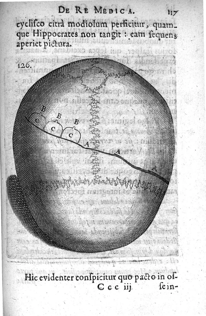 An illustration from A. Cornelii Celsi de Re Medica liber octavus. ejus priora quatuor Capita Commentariis illustrata a Petro Paaw, 1616, leaf 118