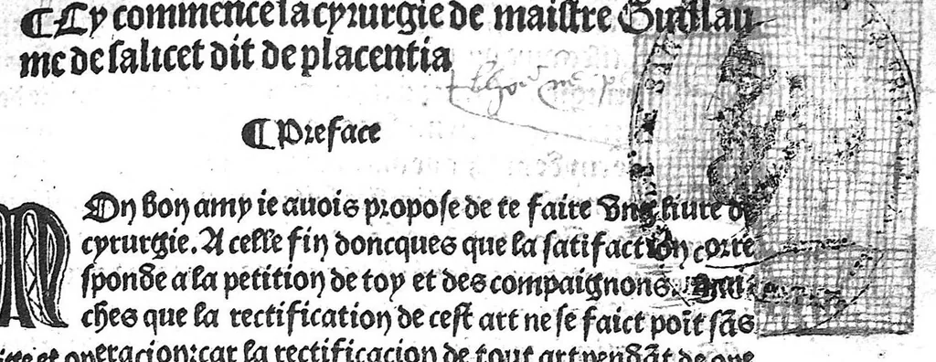 An illustration from La cyrurgie de maistre Guillaume de Salicet, 1505, leaf 2