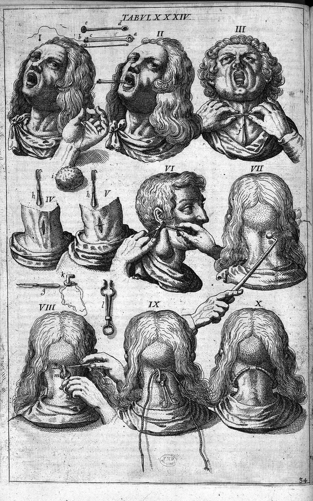 An illustration from Cheiroplotheke, seu... Armamentarium chirurgicum XLIII tabulis... exornatum. Opus posthumum..., 1655, leaf 101