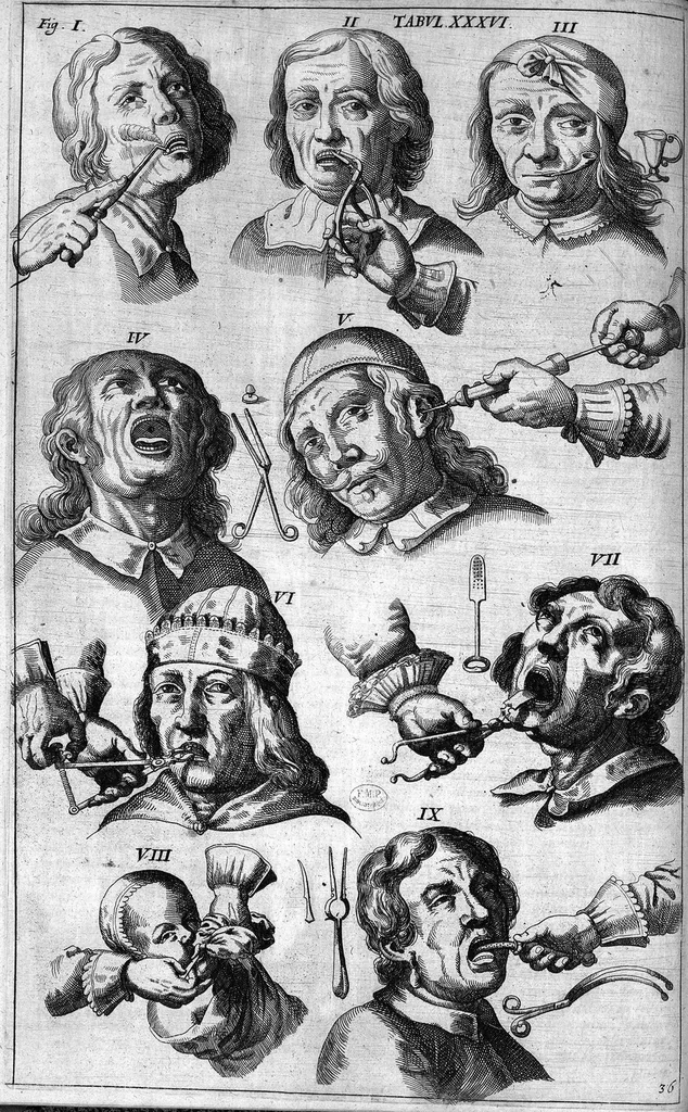 An illustration from Cheiroplotheke, seu... Armamentarium chirurgicum XLIII tabulis... exornatum. Opus posthumum..., 1655, leaf 109