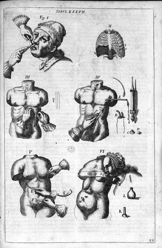 An illustration from Cheiroplotheke, seu... Armamentarium chirurgicum XLIII tabulis... exornatum. Opus posthumum..., 1655, leaf 112