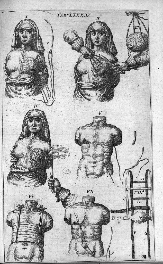 An illustration from Cheiroplotheke, seu... Armamentarium chirurgicum XLIII tabulis... exornatum. Opus posthumum..., 1655, leaf 118