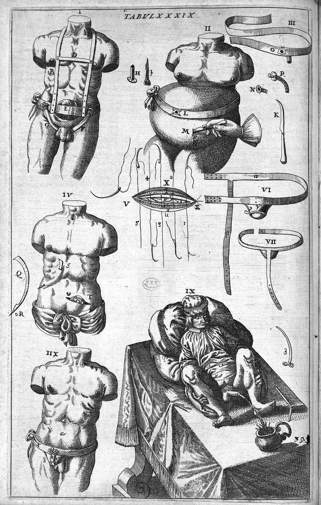 An illustration from Cheiroplotheke, seu... Armamentarium chirurgicum XLIII tabulis... exornatum. Opus posthumum..., 1655, leaf 119