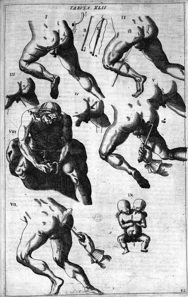 An illustration from Cheiroplotheke, seu... Armamentarium chirurgicum XLIII tabulis... exornatum. Opus posthumum..., 1655, leaf 132