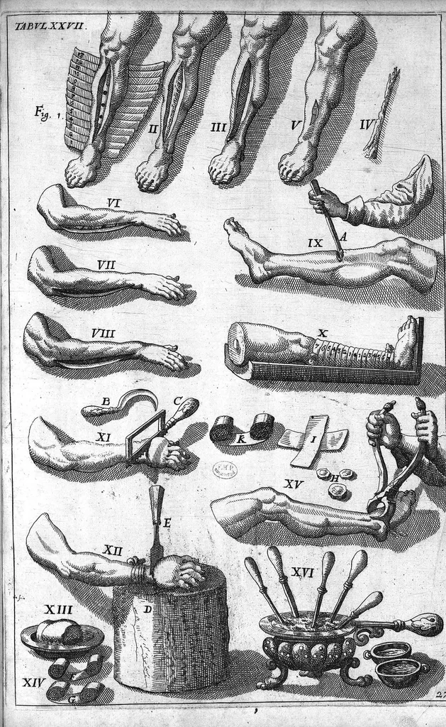 An illustration from Cheiroplotheke, seu... Armamentarium chirurgicum XLIII tabulis... exornatum. Opus posthumum..., 1655, leaf 66
