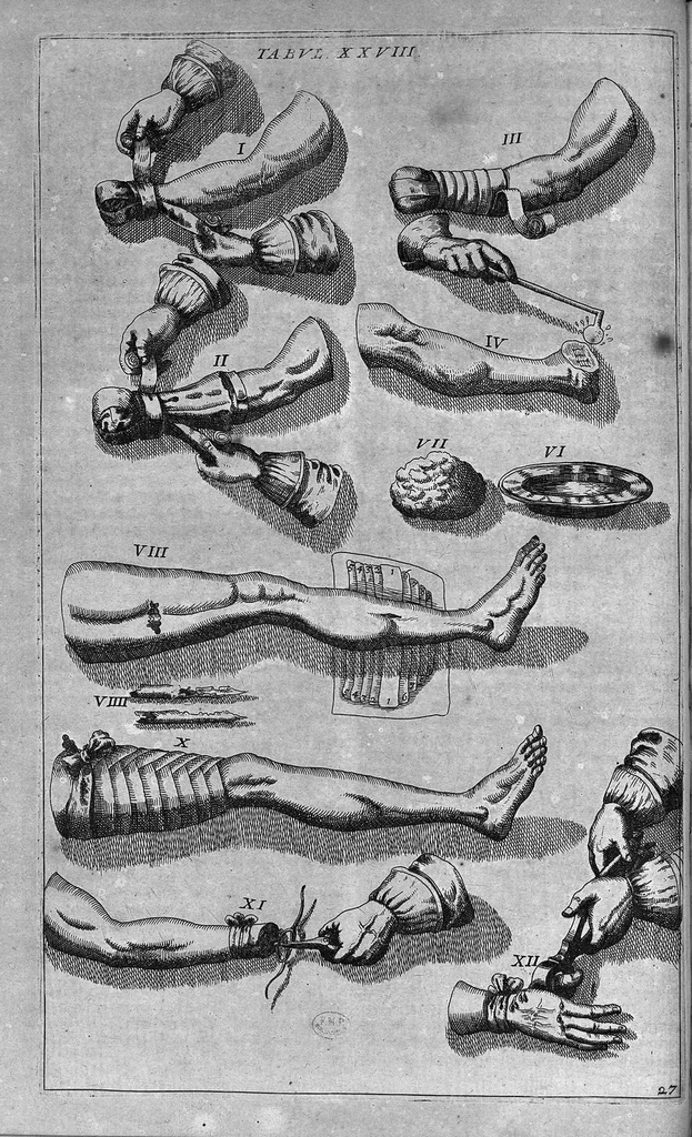 An illustration from Cheiroplotheke, seu... Armamentarium chirurgicum XLIII tabulis... exornatum. Opus posthumum..., 1655, leaf 67