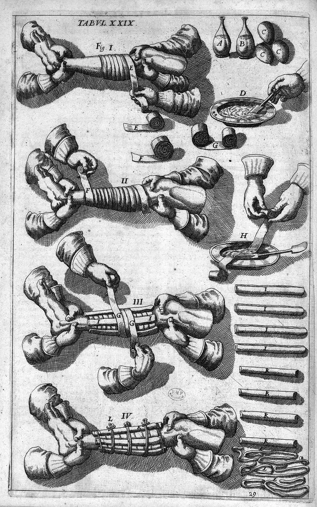 An illustration from Cheiroplotheke, seu... Armamentarium chirurgicum XLIII tabulis... exornatum. Opus posthumum..., 1655, leaf 81