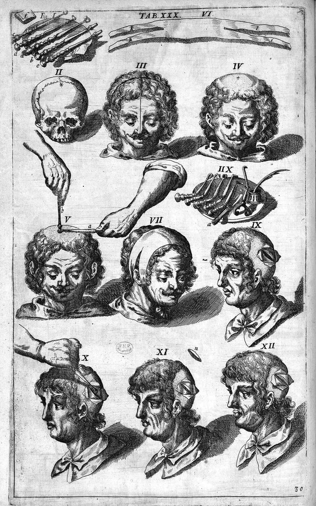 An illustration from Cheiroplotheke, seu... Armamentarium chirurgicum XLIII tabulis... exornatum. Opus posthumum..., 1655, leaf 83