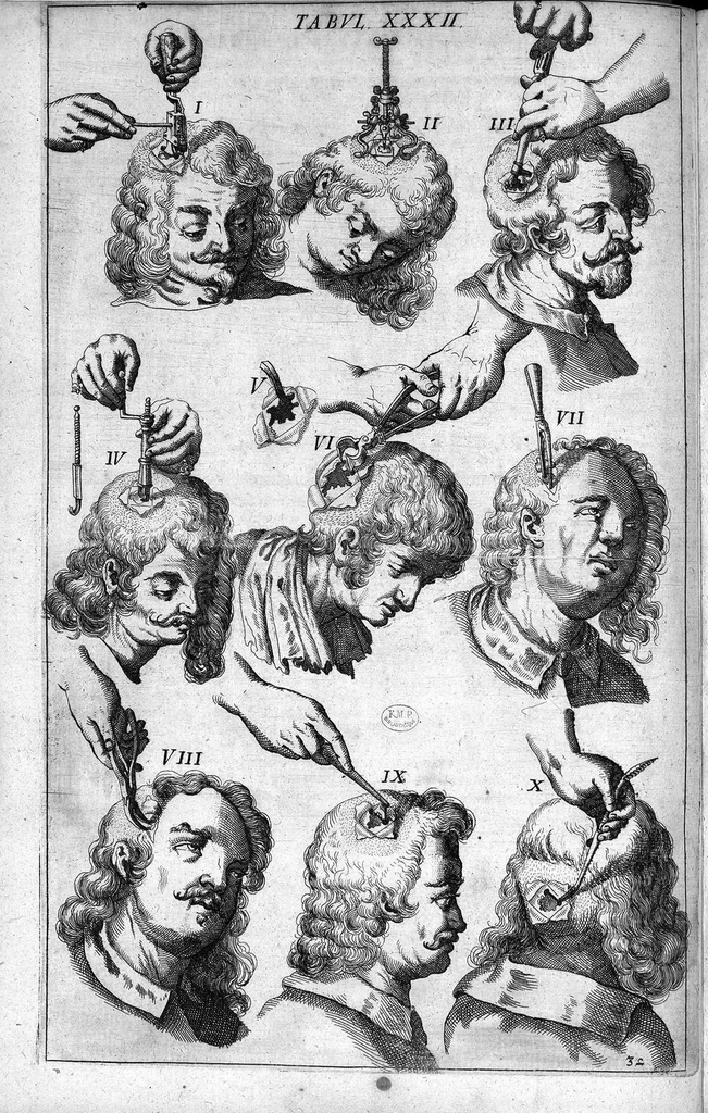 An illustration from Cheiroplotheke, seu... Armamentarium chirurgicum XLIII tabulis... exornatum. Opus posthumum..., 1655, leaf 87