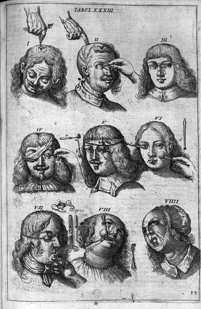 An illustration from Cheiroplotheke, seu... Armamentarium chirurgicum XLIII tabulis... exornatum. Opus posthumum..., 1655, leaf 96