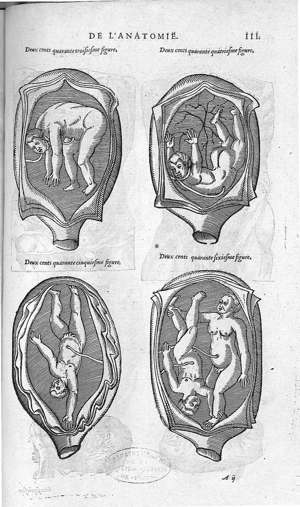 An illustration from Les Oeuvres d’Ambroise Paré, conseiller et premier chirurgien du roy, divisées en vingt-sept livres : avec les figures et portraicts tant de l’Anatomie que des instruments de chirurgie et de plusieurs monstres : reveuz et augmentez par l’autheur pour la seconde Edition, Paris,, 1579, leaf 1241